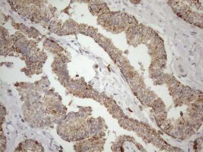 Immunohistochemistry: LIME Antibody (OTI5D3) - Azide and BSA Free [NBP2-71974] - Analysis of Carcinoma of Human prostate tissue. (Heat-induced epitope retrieval by 1mM EDTA in 10mM Tris buffer (pH8.5) at 120C for 3 min)