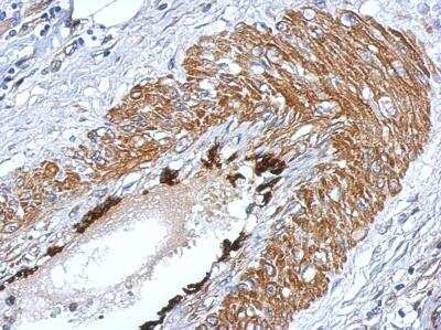 Immunohistochemistry-Paraffin: LIN-28A Antibody [NBP2-19355] -  Immunohistochemical analysis of paraffin-embedded Gastric ca, using antibody at 1:500 dilution.