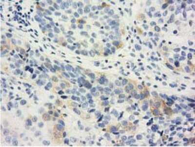 Immunohistochemistry-Paraffin: LIN7B Antibody (1C9) [NBP2-02852] - Staining of paraffin-embedded Carcinoma of Human bladder tissue using anti-LIN7B mouse monoclonal antibody.