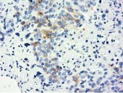 Immunohistochemistry: LIN7B Antibody (OTI1C9) - Azide and BSA Free [NBP2-72131] - Staining of paraffin-embedded Adenocarcinoma of Human ovary tissue using anti-LIN7B mouse monoclonal antibody.