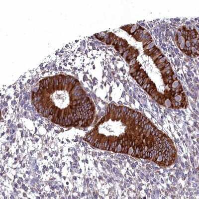 Immunohistochemistry-Paraffin: LIV-1/Zip6 Antibody [NBP2-13337] - Staining of human uterus, post-menopause shows strong cytoplasmic positivity in glandular cells.