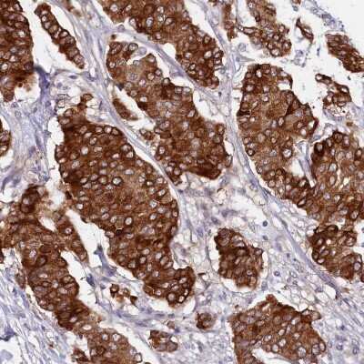 Immunohistochemistry-Paraffin: LIV-1/Zip6 Antibody [NBP2-13337] - Staining of human breast cancer shows strong cytoplasmic positivity in tumor cells.