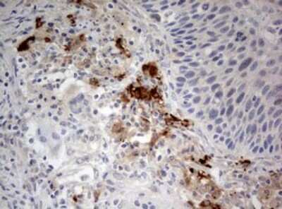 Immunohistochemistry: LKB1/STK11 Antibody (0A3) [NBP2-45460] - Analysis of Carcinoma of Human lung tissue.(Heat-induced epitope retrieval by 10mM citric buffer, pH6.0, 120C for 3min)