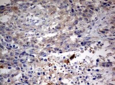 Immunohistochemistry: LKB1/STK11 Antibody (0A3) [NBP2-45460] - Analysis of Adenocarcinoma of Human ovary tissue. (Heat-induced epitope retrieval by 10mM citric buffer, pH6.0, 120C for 3min)