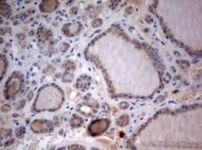 Immunohistochemistry: LKB1/STK11 Antibody (0A3) [NBP2-45460] - Analysis of Carcinoma of Human thyroid tissue. (Heat-induced epitope retrieval by 10mM citric buffer, pH6.0, 120C for 3min)