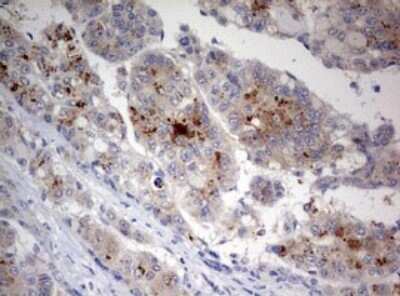 Immunohistochemistry: LKB1/STK11 Antibody (OTI0A3) - Azide and BSA Free [NBP2-71300] - Analysis of Carcinoma of Human liver tissue. (Heat-induced epitope retrieval by 10mM citric buffer, pH6.0, 120C for 3min)