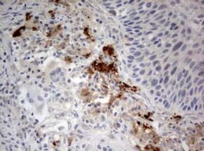 Immunohistochemistry: LKB1/STK11 Antibody (OTI0A3) - Azide and BSA Free [NBP2-71300] - Analysis of Carcinoma of Human lung tissue.(Heat-induced epitope retrieval by 10mM citric buffer, pH6.0, 120C for 3min)