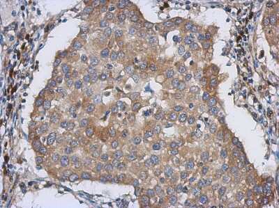 Immunohistochemistry-Paraffin: LMAN1 Antibody [NBP2-19366] - Immunohistochemical analysis of paraffin-embedded Breast ca, using antibody at 1:500 dilution.