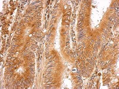 Immunohistochemistry-Paraffin: LMAN1 Antibody [NBP2-19366] - LMAN1 antibody [N1C1] detects LMAN1 protein at cytosol on gastric carcinoma by immunohistochemical analysis. Sample: Paraffin-embedded gastric carcinoma. LMAN1 antibody [N1C1] dilution: 1:500.