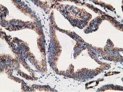 Immunohistochemistry: LMAN1 Antibody (OTI1A8) - Azide and BSA Free [NBP2-71152] - Staining of paraffin-embedded Carcinoma of Human prostate tissue using anti-LMAN1 mouse monoclonal antibody.