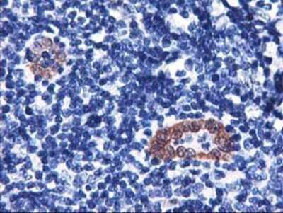 Immunohistochemistry: LMCD1 Antibody (OTI1H5) - Azide and BSA Free [NBP2-71865] - Staining of paraffin-embedded Human lymphoma tissue using anti-LMCD1 mouse monoclonal antibody.