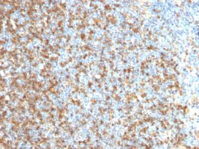 Immunohistochemistry-Paraffin: LMO2 Antibody (LMO2/1971) - Azide and BSA Free [NBP3-08268] - Formalin-fixed, paraffin-embedded human Follicular Lymphoma stained with LMO2 Mouse Monoclonal Antibody (LMO2/1971).