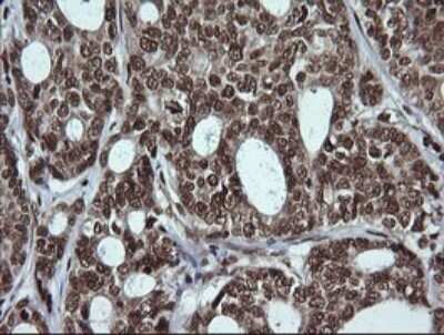 Immunohistochemistry: LMO2 Antibody (OTI1G10) - Azide and BSA Free [NBP2-71157] - Analysis of Adenocarcinoma of Human breast tissue. (Heat-induced epitope retrieval by 10mM citric buffer, pH6.0, 120C for 3min)
