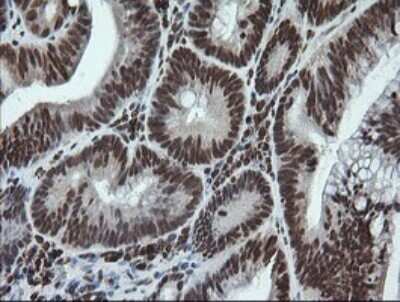 Immunohistochemistry: LMO2 Antibody (OTI1G10) - Azide and BSA Free [NBP2-71157] - Analysis of Adenocarcinoma of Human colon tissue. (Heat-induced epitope retrieval by 10mM citric buffer, pH6.0, 120C for 3min)