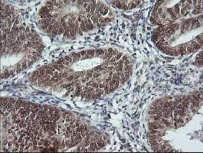 Immunohistochemistry: LMO2 Antibody (OTI1G10) - Azide and BSA Free [NBP2-71157] - Analysis of Adenocarcinoma of Human endometrium tissue. (Heat-induced epitope retrieval by 10mM citric buffer, pH6.0, 120C for 3min)