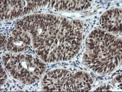 Immunohistochemistry: LMO2 Antibody (OTI1G10) - Azide and BSA Free [NBP2-71157] - Analysis of Adenocarcinoma of Human ovary tissue. (Heat-induced epitope retrieval by 10mM citric buffer, pH6.0, 120C for 3min)