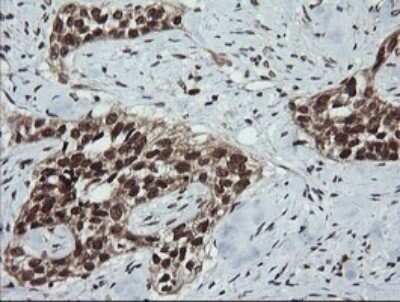 Immunohistochemistry: LMO2 Antibody (OTI1G10) - Azide and BSA Free [NBP2-71157] - Analysis of Carcinoma of Human bladder tissue. (Heat-induced epitope retrieval by 10mM citric buffer, pH6.0, 120C for 3min)