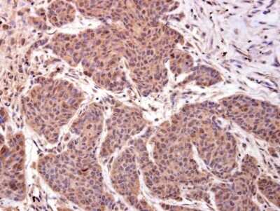 Immunohistochemistry-Paraffin: LMO4 Antibody [NBP2-43538] - Analysis of human breast carcinoma. LMO4 antibody diluted at 1:500.