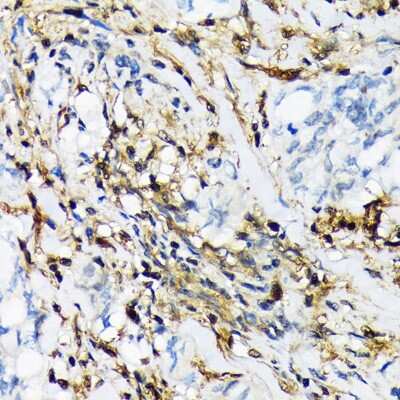 Immunohistochemistry-Paraffin: LMP2/PSMB9 Antibody (7Q2G4) [NBP3-16823] - Immunohistochemistry of paraffin-embedded human lung cancer using LMP2/PSMB9 Rabbit mAb (NBP3-16823) at dilution of 1:100 (40x lens).Perform microwave antigen retrieval with 10 mM Tris/EDTA buffer pH 9.0 before commencing with IHC staining protocol.