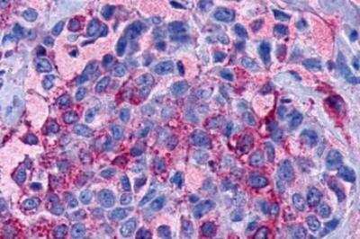 Immunohistochemistry-Paraffin: LPAR2/LPA2/EDG-4 Antibody [NLS1014] - Human Breast, Carcinoma paraffin-embedded tissue after heat-induced antigen retrieval.