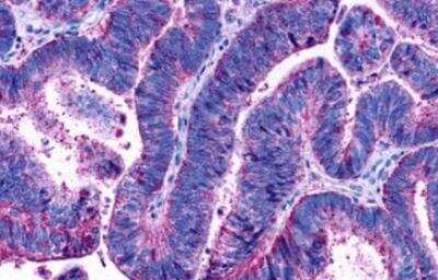 Immunohistochemistry-Paraffin: LPAR2/LPA2/EDG-4 Antibody [NLS1014] - Human Colon, Carcinoma formalin-fixed, paraffin-embedded tissue after heat-induced antigen retrieval.