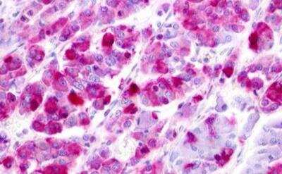 Immunohistochemistry-Paraffin: LPAR5/LPA5/GPR92 Antibody [NLS428] - Pancreas, carcinoma
