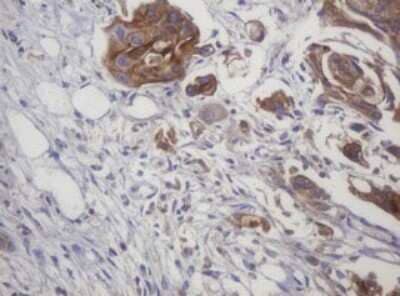 Immunohistochemistry: LRCH4 Antibody (1F8) [NBP2-45795] - Analysis of Carcinoma of Human bladder tissue. (Heat-induced epitope retrieval by 10mM citric buffer, pH6.0, 120C for 3min)