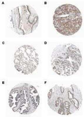 Immunohistochemistry-Paraffin: LRDD Antibody (Anto-1) [NBP1-97595] - Staining of endogenous human PIDD in different human tissues (paraffin sections) using MAb to PIDD (Anto-1). Method: Different human normal (A: Bronchus; B: Kidney; C: Lung) or cancer (D: Breast; E: Ovarian; F: Colo-rectal) tissues were stained with MAb to PIDD (Anto-1) by standard immunohistochemistry.