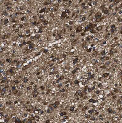 Immunohistochemistry-Paraffin: LRIG1 Antibody [NBP2-30926] - Staining of human glioma shows moderate to strong cytoplasmic positivity in tumor cells.