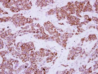 Immunohistochemistry-Paraffin: LRRC23 Antibody [NBP2-17169] - Immunohistochemical analysis of paraffin-embedded Breast ca, using antibody at 1:250 dilution.