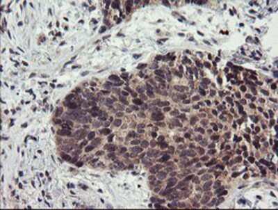 Immunohistochemistry-Paraffin: LRRC25 Antibody (1D9) [NBP2-03747] - Staining of paraffin-embedded Carcinoma of Human lung tissue using anti-LRRC25 mouse monoclonal antibody.