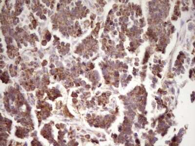 Immunohistochemistry: LRRC6 Antibody (7E9) [NBP2-45674] - Analysis of Adenocarcinoma of Human ovary tissue. (Heat-induced epitope retrieval by 1 mM EDTA in 10mM Tris, pH8.5, 120C for 3min)
