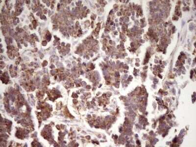 Immunohistochemistry: LRRC6 Antibody (OTI7E9) - Azide and BSA Free [NBP2-72542] - Analysis of Adenocarcinoma of Human ovary tissue. (Heat-induced epitope retrieval by 1 mM EDTA in 10mM Tris, pH8.5, 120C for 3min)
