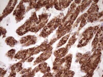Immunohistochemistry: LRRC6 Antibody (OTI7E9) - Azide and BSA Free [NBP2-72542] - Analysis of Carcinoma of Human liver tissue.(Heat-induced epitope retrieval by 1 mM EDTA in 10mM Tris, pH8.5, 120C for 3min)