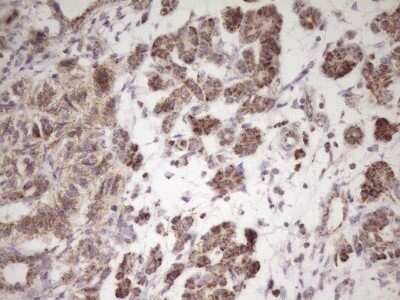 Immunohistochemistry: LRRC6 Antibody (OTI7E9) - Azide and BSA Free [NBP2-72542] - Analysis of Carcinoma of Human pancreas tissue. (Heat-induced epitope retrieval by 1 mM EDTA in 10mM Tris, pH8.5, 120C for 3min)
