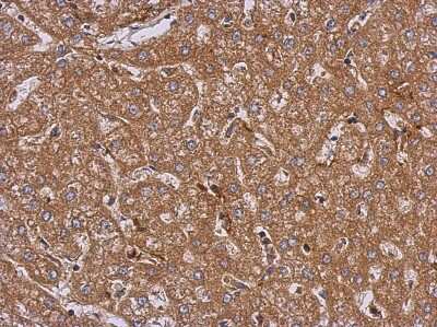 Immunohistochemistry-Paraffin: LRRN2 Antibody [NBP2-17175] - Immunohistochemical analysis of paraffin-embedded Hepatoma, using antibody at 1:500 dilution.