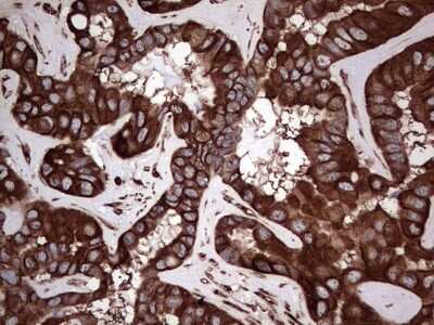 Immunohistochemistry: LRRTM1 Antibody (5H9) [NBP2-45675] - Analysis of Carcinoma of Human liver tissue.(Heat-induced epitope retrieval by 1 mM EDTA in 10mM Tris, pH8.5, 120C for 3min)