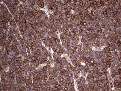 Immunohistochemistry: LRRTM1 Antibody (5H9) [NBP2-45675] - Analysis of Human lymphoma tissue. (Heat-induced epitope retrieval by 1 mM EDTA in 10mM Tris, pH8.5, 120C for 3min)