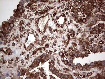 Immunohistochemistry: LRRTM1 Antibody (OTI5H9) - Azide and BSA Free [NBP2-72543] - Analysis of Adenocarcinoma of Human ovary tissue. (Heat-induced epitope retrieval by 1 mM EDTA in 10mM Tris, pH8.5, 120C for 3min)