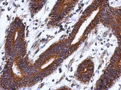 Immunohistochemistry-Paraffin: LSG1 Antibody [NBP2-17178] - Immunohistochemical analysis of paraffin-embedded Colon ca, using antibody at 1:500 dilution.