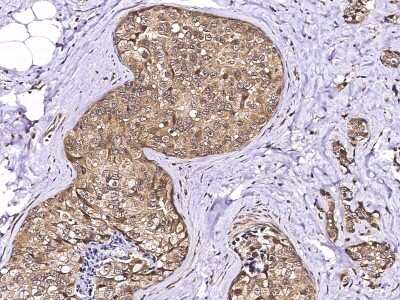 Immunohistochemistry-Paraffin: LSM1 Antibody [NBP3-00249] - Immunochemical staining of human LSM1 in human breast carcinoma with rabbit polyclonal antibody (1:10000, formalin-fixed paraffin embedded sections).