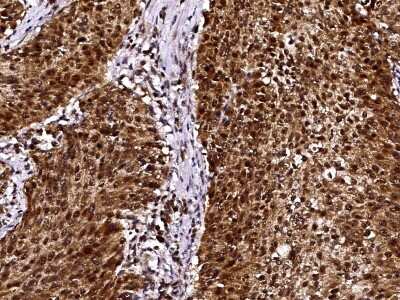 Immunohistochemistry-Paraffin: LSM1 Antibody [NBP3-00249] - Immunochemical staining of human LSM1 in human lung carcinoma with rabbit polyclonal antibody (1:10000, formalin-fixed paraffin embedded sections).