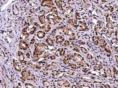 Immunohistochemistry-Paraffin: LSM1 Antibody [NBP3-00249] - Immunochemical staining of human LSM1 in human prostatic carcinoma with rabbit polyclonal antibody (1:10000, formalin-fixed paraffin embedded sections).