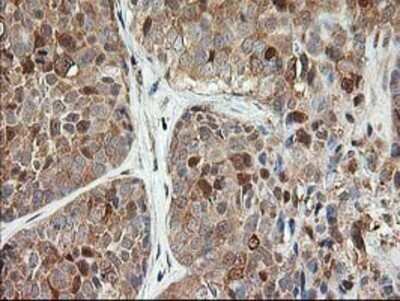 Immunohistochemistry: LSM1 Antibody (OTI5C6) - Azide and BSA Free [NBP2-72547] - Staining of paraffin-embedded Adenocarcinoma of Human breast tissue using anti-LSM1 mouse monoclonal antibody.