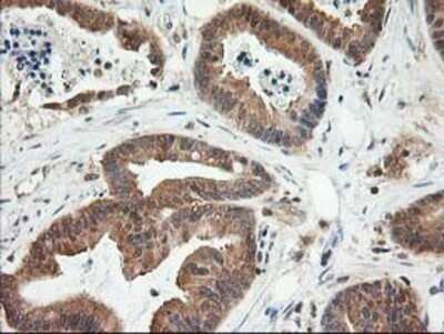 Immunohistochemistry: LSM1 Antibody (OTI5C6) - Azide and BSA Free [NBP2-72547] - Staining of paraffin-embedded Adenocarcinoma of Human colon tissue using anti-LSM1 mouse monoclonal antibody.