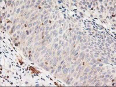 Immunohistochemistry: LSM1 Antibody (OTI5C6) - Azide and BSA Free [NBP2-72547] - Staining of paraffin-embedded Carcinoma of Human bladder tissue using anti-LSM1 mouse monoclonal antibody.