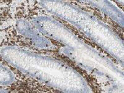 Immunohistochemistry: LSP1 Antibody [24780002] - staining for lymphocyte-specific protein 1 (LSP1) in human lymphoidal  tissues.  Lymphoid tissues of appendix displayed moderate to strong cytoplasmic positivity.  Normal epithelial and stromal cells were negative.  Most malignant lymphomas and a few cases of urothelial cancers expressed moderate cytoplasmic immunoreactivity (images not shown).  These image are the courtesy of the Human Proteome Resource (HPR).