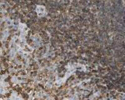 Immunohistochemistry: LSP1 Antibody [24780002] - Staining for lymphocyte-specific protein 1 (LSP1) in human lymphoidal  tissues.  Lymphoid tissues of tonsil displayed moderate to strong cytoplasmic positivity.  Normal epithelial and stromal cells were negative.  Most malignant lymphomas and a few cases of urothelial cancers expressed moderate cytoplasmic immunoreactivity (images not shown).  These image are the courtesy of the Human Proteome Resource (HPR).