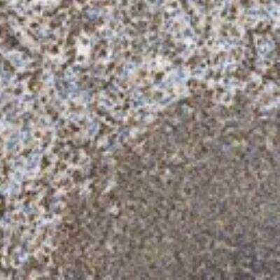 Immunohistochemistry: LSP1 Antibody [24780002] - Lymphoid tissues displayed moderate to strong cytoplasmic positivity. Normal epithelial and stromal cells were negative. Among malignant cells, most malignant lymphomas and a few cases of urothelial cancers expressed moderate cytoplasmic immunoreactivity.  Image and statement courtesy of the Human Protein Atlas (HPA).