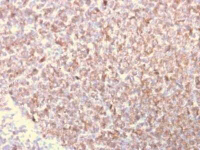 Immunohistochemistry-Paraffin: LSP1 Antibody (LSP1/3025) - Azide and BSA Free [NBP2-79859] - Formalin-fixed, paraffin-embedded human Lymphoma stained with LSP1 Antibody (LSP1/3025).